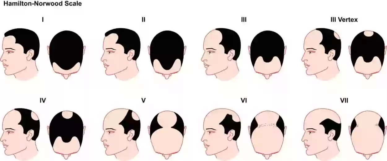 زراعة الشعر جدة كم تكلف ومن أحسن دكتور لزراعة الشعر في جدة؟